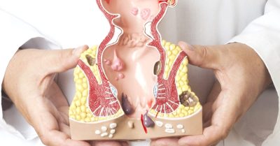 Sau phẫu thuật trĩ cần lưu ý gì?