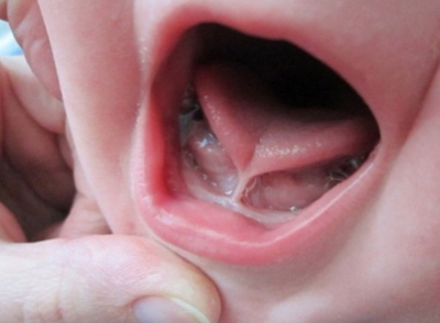 Dính thắng lưỡi ở trẻ là gì, nguy hiểm không?
