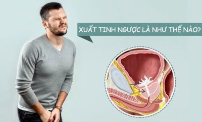 Xuất tinh ngược là gì, nguy hiểm không?