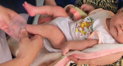 Bàn chân khoèo ở trẻ: Những điều cần biết