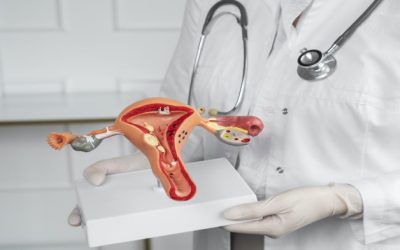 Những điều cần biết về polyp cổ tử cung