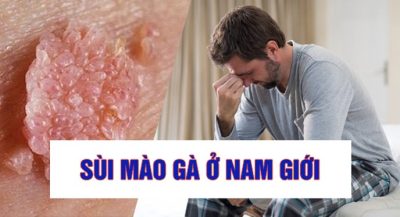 Khám sức khỏe tiền hôn nhân phát hiện ra sùi mào gà