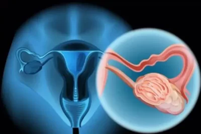 Tắc vòi trứng: Nguyên nhân thường gặp gây vô sinh hiếm muộn