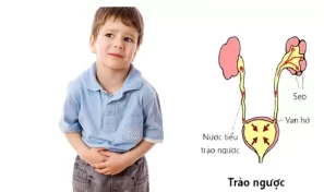 Trào ngược bàng quang niệu quản là gì?