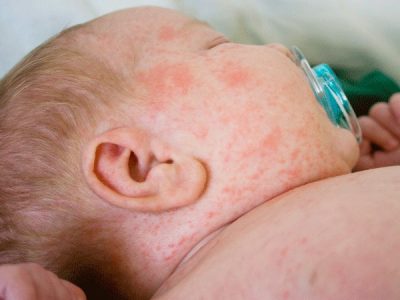 Viêm da cơ địa ở trẻ: Những điều cần biết