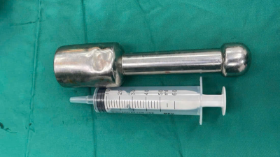 Thiếu niên 15 tuổi đưa dị vật dài 18cm vào cơ thể