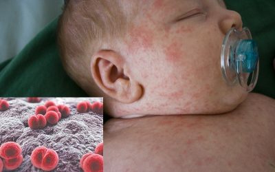 Viêm não mô cầu là bệnh gì, nguy hiểm thế nào?