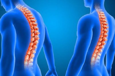 Loãng xương: Nguyên nhân và dấu hiệu nhận biết