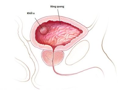 U bàng quang là gì, có nguy hiểm không?