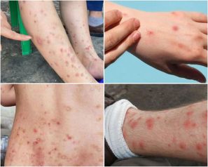Viêm da do bọ chét: Những điều cần biết