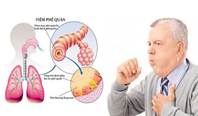 Những dấu hiệu cảnh báo viêm phế quản ở người lớn
