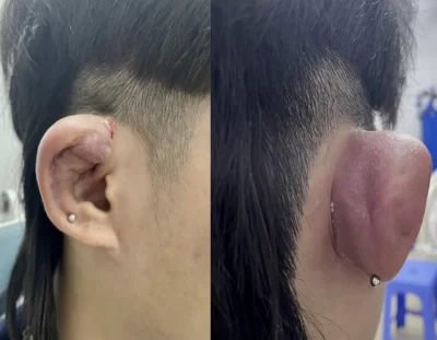 Áp xe sụn vành tai nguy hiểm thế nào?