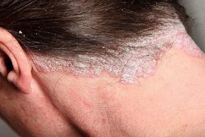 Nấm da đầu là gì, nguyên nhân do đâu?
