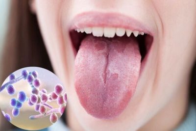 Nấm lưỡi: Nguyên nhân, triệu chứng và cách điều trị