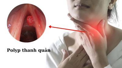 Polyp thanh quản: Những điều cần biết