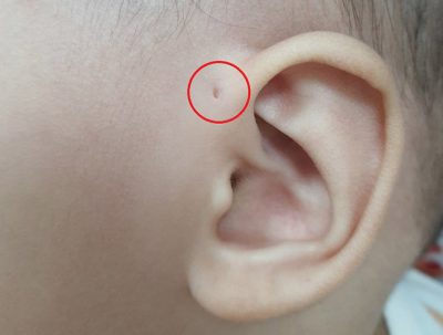 Rò luân nhĩ là gì, có nguy hiểm không?