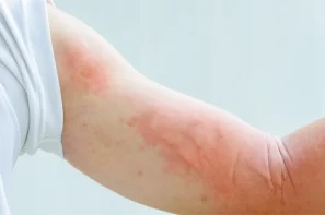 Sốt xuất huyết ở người lớn: Những dấu hiệu cảnh báo