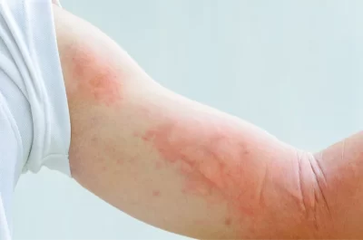 Sốt xuất huyết ở người lớn: Những dấu hiệu cảnh báo