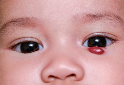 Dấu hiệu nhận biết u máu ở trẻ sơ sinh