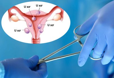 U xơ tử cung có cần mổ không? Trường hợp nào cần phẫu thuật?