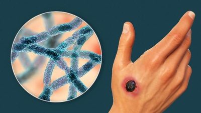 Bệnh than: Nỗi ám ảnh của không ít người