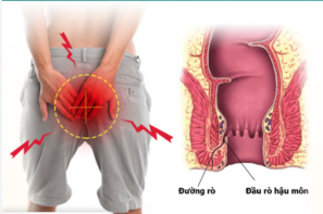 Rò hậu môn: Nguyên nhân, triệu chứng và cách điều trị