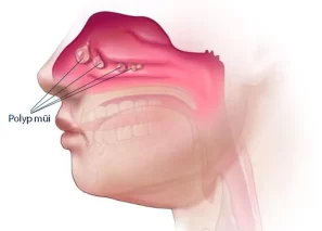 Khám sức khỏe ra polyp mũi thì phải làm gì?