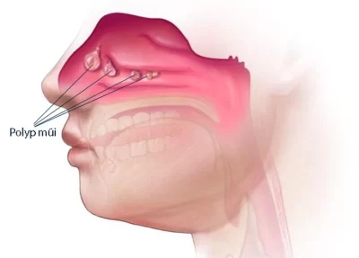 Khám sức khỏe ra polyp mũi thì phải làm gì?