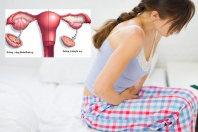 Suy buồng trứng ở phụ nữ trẻ: Không thể chủ quan