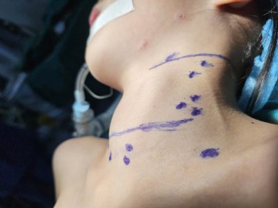 Phát hiện ung thư tuyến giáp ở bé gái 7 tuổi: Những dấu hiệu cảnh báo