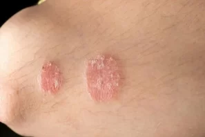 Bệnh vảy nến: Những điều cần biết