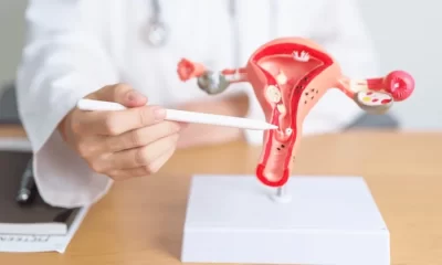 Những dấu hiệu polyp cổ tử cung chị em cần biết
