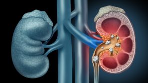 Các loại sỏi tiết niệu thường gặp