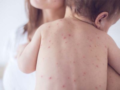 Những dấu hiệu cảnh báo sốt xuất huyết ở trẻ