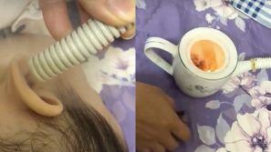 Cẩn trọng tình trạng thổi thuốc, đổ sáp ong… chữa viêm tai giữa