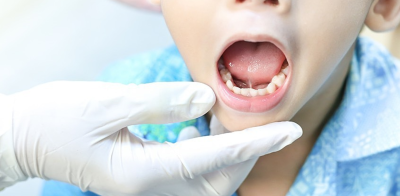 Chăm sóc trẻ sau phẫu thuật cắt dính thắng lưỡi thế nào?