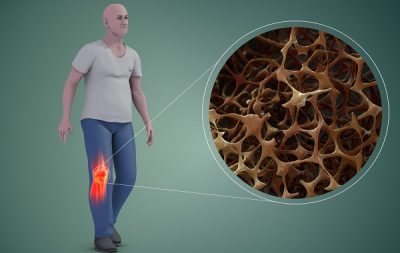 Loãng xương: Những điều nên biết