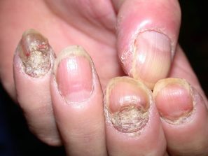 Nấm móng tay có dấu hiệu gì, nguy hiểm hay không?