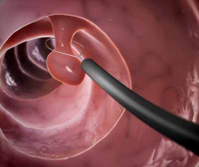 Ra máu bất thường: Dấu hiệu cảnh báo polyp cổ tử cung