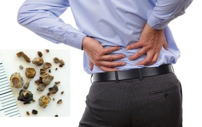 Sỏi tiết niệu gây ứ nước ở thận