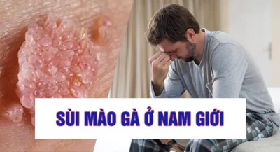 Khám sức khoẻ tiền hôn nhân phát hiện mắc sùi mào gà