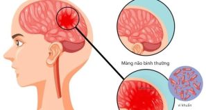 Phòng bệnh não mô cầu như thế nào?