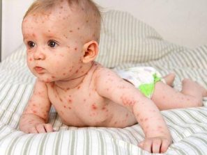 Bệnh sởi ở trẻ lây qua những con đường nào?