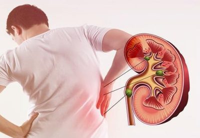 4 thói quen làm tăng nguy cơ bị sỏi thận